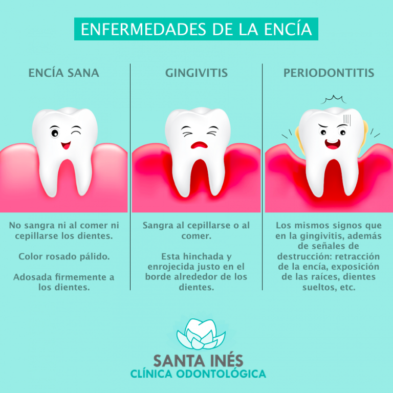 Las Enfermedades De La Encía Santa Inés Clínica Odontológica
